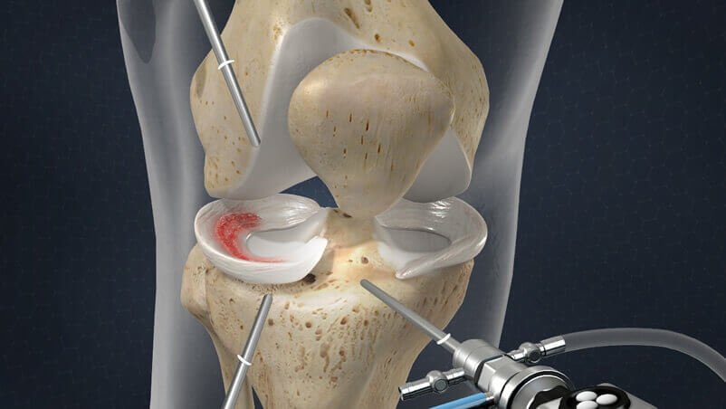 MENISCUS SURGERY drbeekman